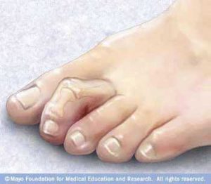 Hammertoes - LA Orthopedic & Pain Center