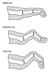 Toe Deformity bone structure