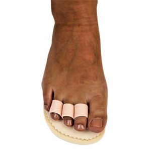Toe deformity treatment with separators