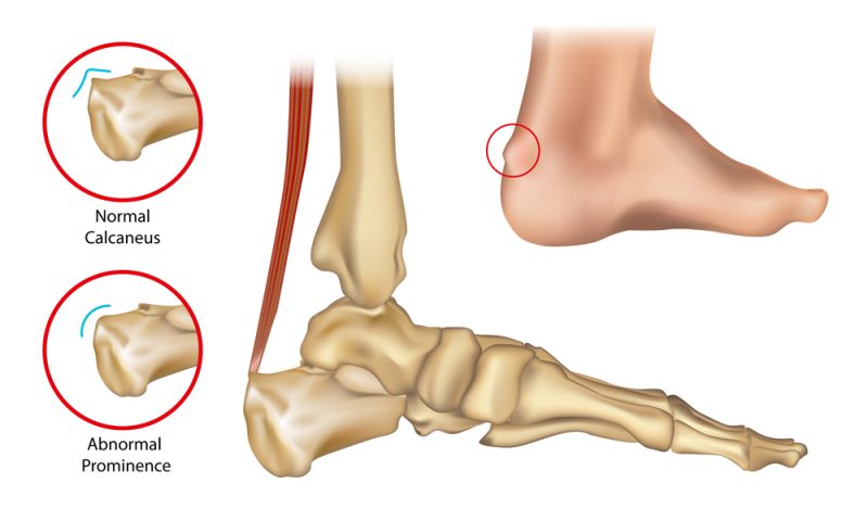 Haglund’s Deformity | Milton Orthotic & Wellness Centre