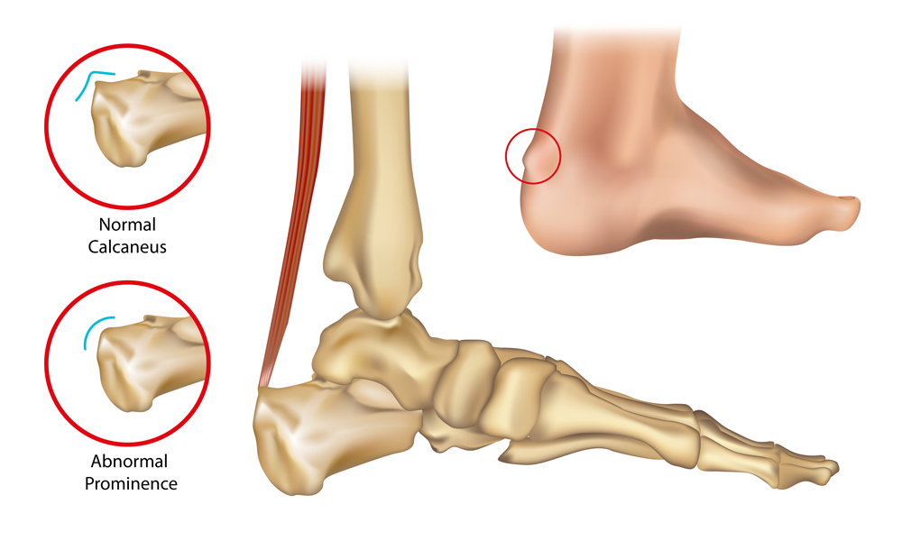  Haglund's Deformity